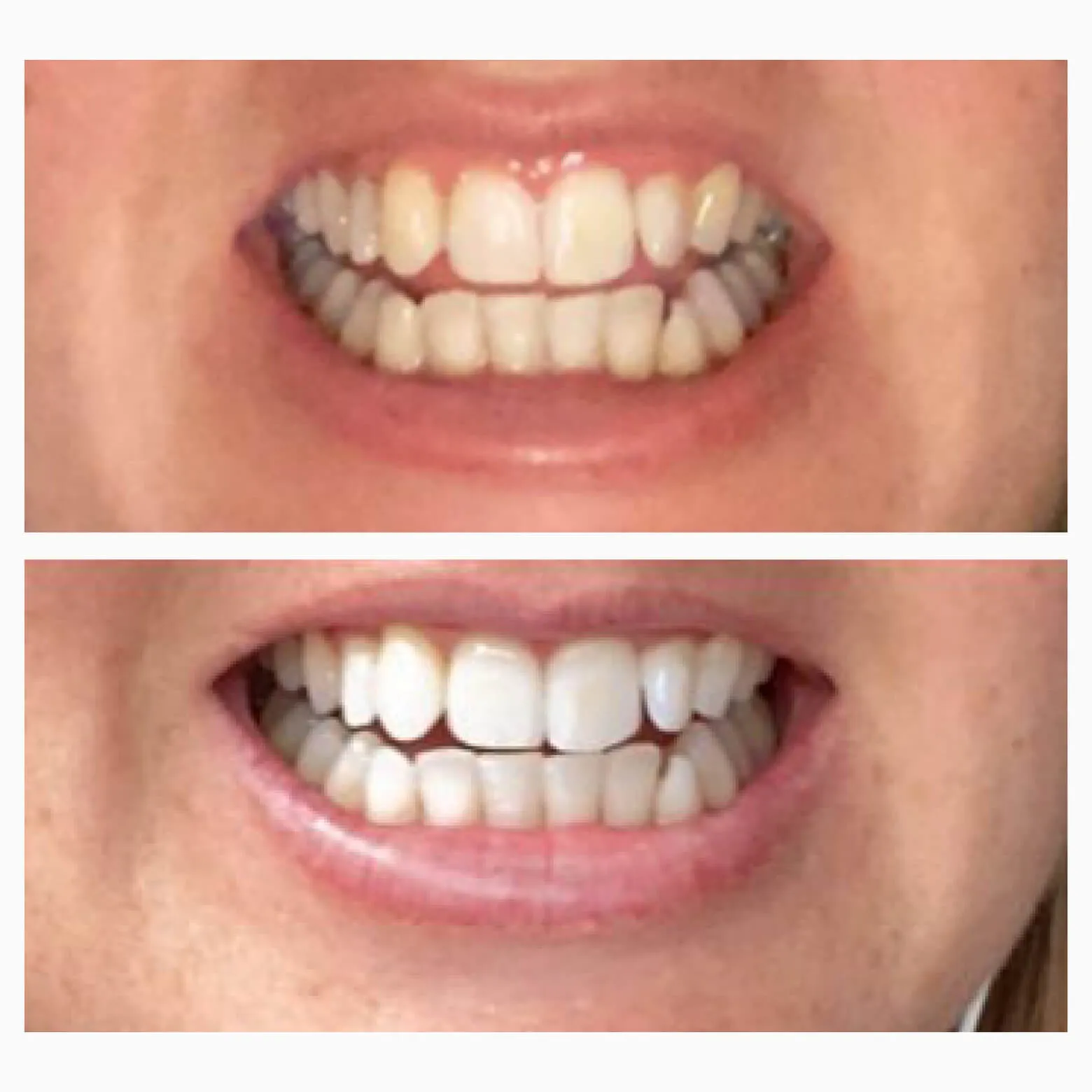 Brighten & Whiten Starter Bundle (Purple Serum   Dissolving Strips)