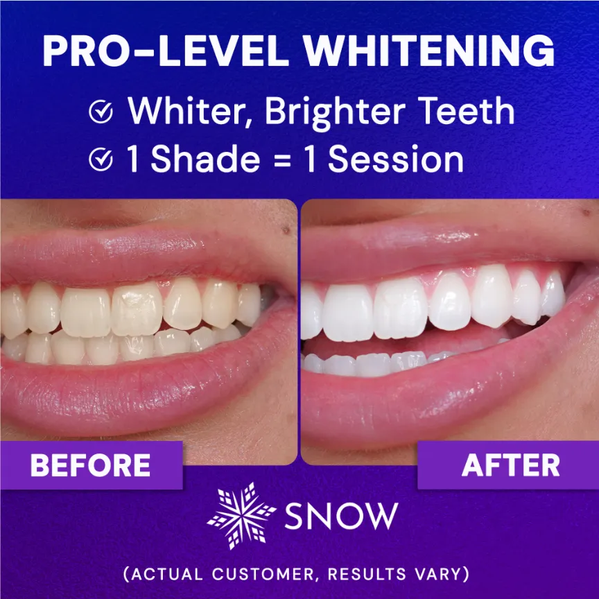 DiamondSeries® Teeth Whitening Kit with Hydroxyapatite & Potassium Nitrate