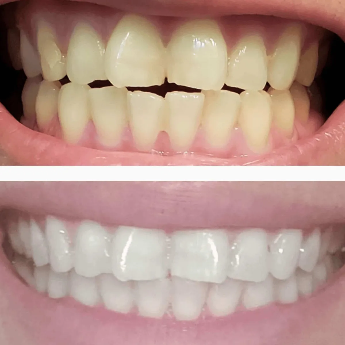DiamondSeries® Teeth Whitening Kit with Hydroxyapatite & Potassium Nitrate