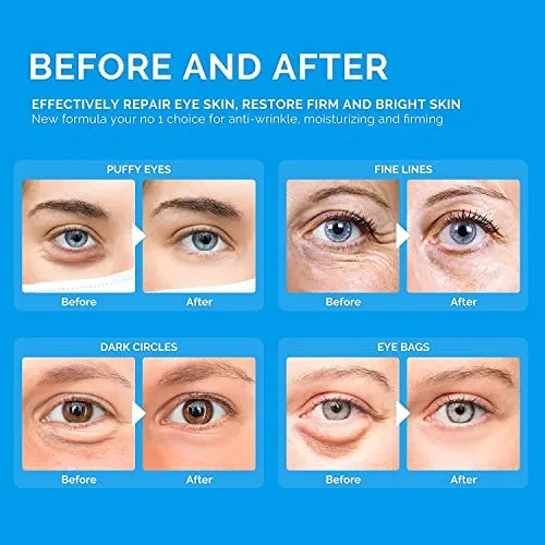 Enaskin Naturals Under Eye Patches Dark Circles Under Eye Masks for Puffiness - Green Tea Eye Gel Pads With Retinol & Collagen & Hyaluronic Acid, Wrinkles Reducing Gels for Eye Bags & Fine Lines