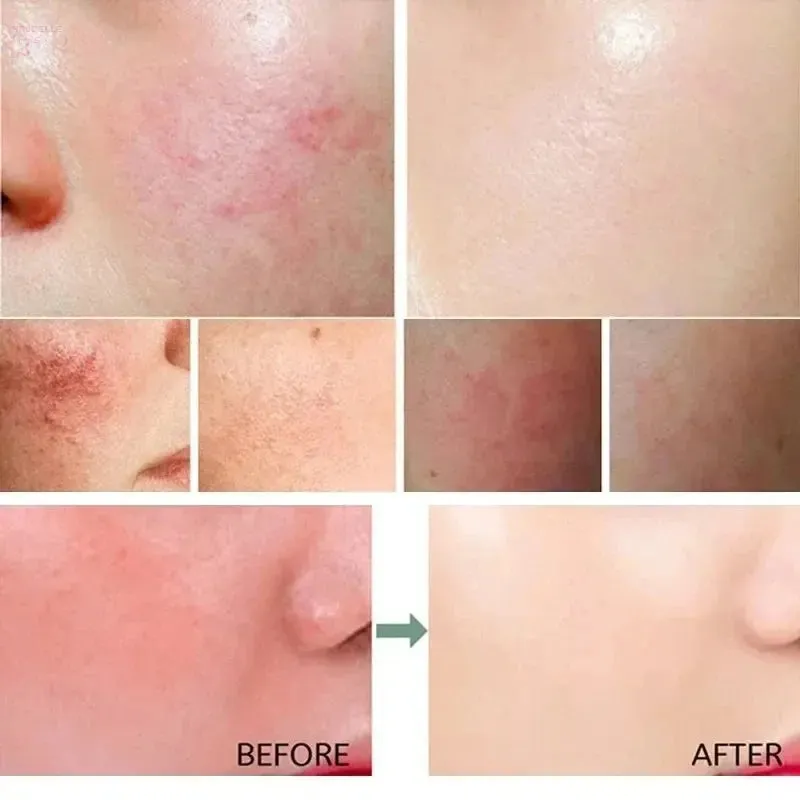 Facial Redness Repair Cream – Soothing & Hydrating Moisturizer for Sensitive Skin